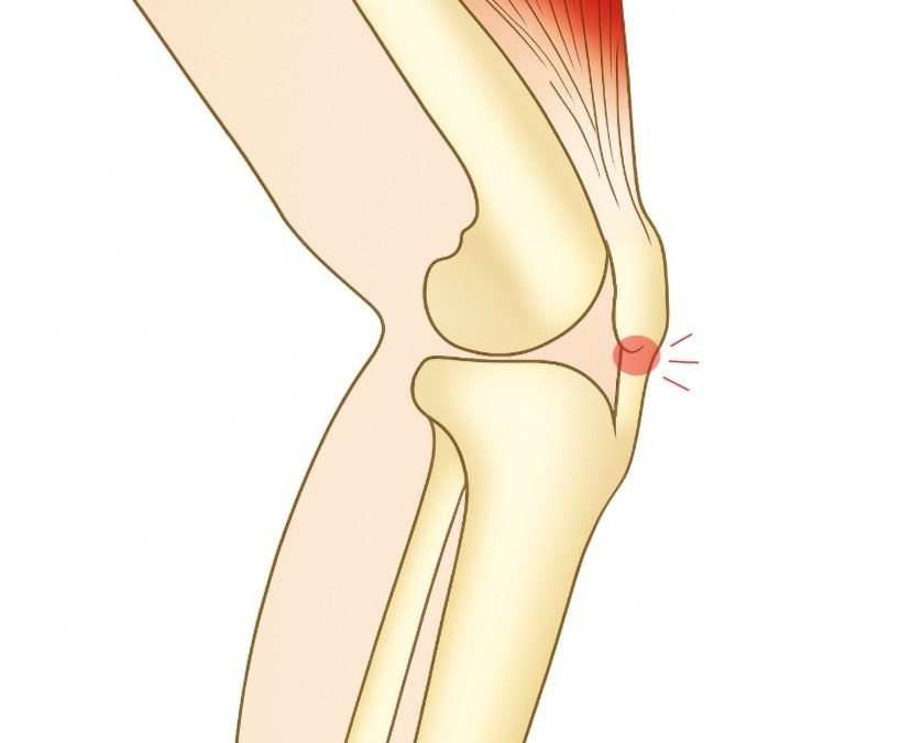 Tränar du mer på semestern? Se upp för hopparknä
